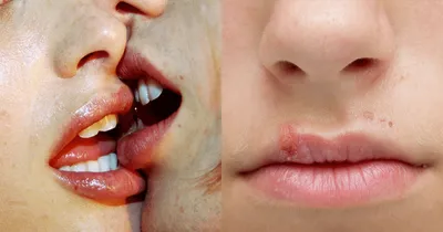 kissing disease  ಕೊರೋನ ಬೆನ್ನಲ್ಲೇ ಕಿಸ್ಸಿಂಗ್ ಕಾಯಿಲೆ ಎಂಟ್ರಿ  ಆಸ್ಪತ್ರೆಗೆ ದಾಖಲಾದ ವಿದ್ಯಾರ್ಥಿ  ಏನಿದು ಜೀವ ತೆಗಿಯೋ ಹೊಸ ಕಾಯಿಲೆ 