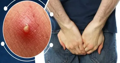 butt acne  ಹಿಂಬದಿ ಆಗೋ ಮೊಡವೆ  ಕಜ್ಜಿಗಳಿಂದ ರೋಸಿ ಹೋಗಿದ್ದೀರಾ   ಇಲ್ಲಿದೆ ಸುಲಭ ಪರಿಹಾರ