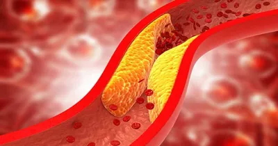 cholesterol ಹೆಚ್ಚಾದರೆ ದೇಹದಲ್ಲಿ ಈ ಲಕ್ಷಣಗಳು ಕಾಣುತ್ತೆ  ಎಚ್ಚರ 